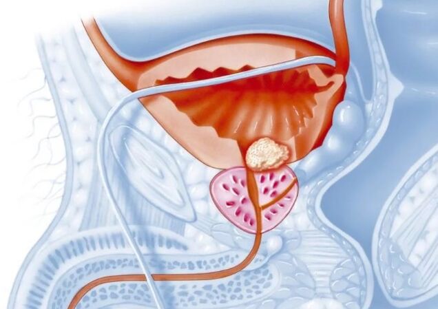 Características da forma crônica de prostatite
