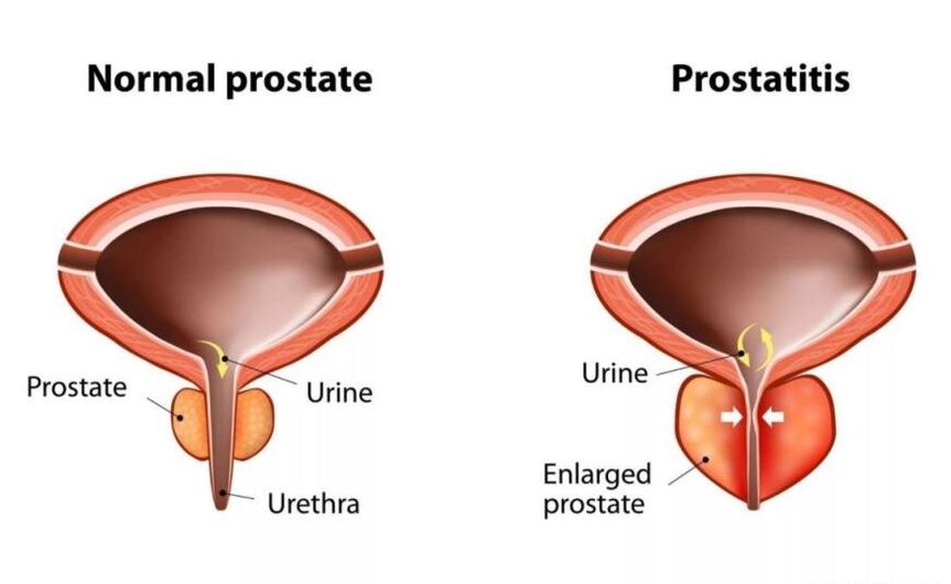Próstata normal e inflamada