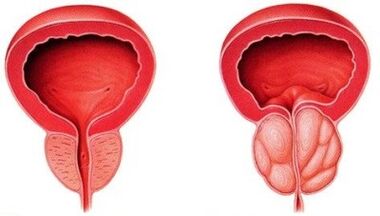 Próstata saudável e inflamada com prostatite